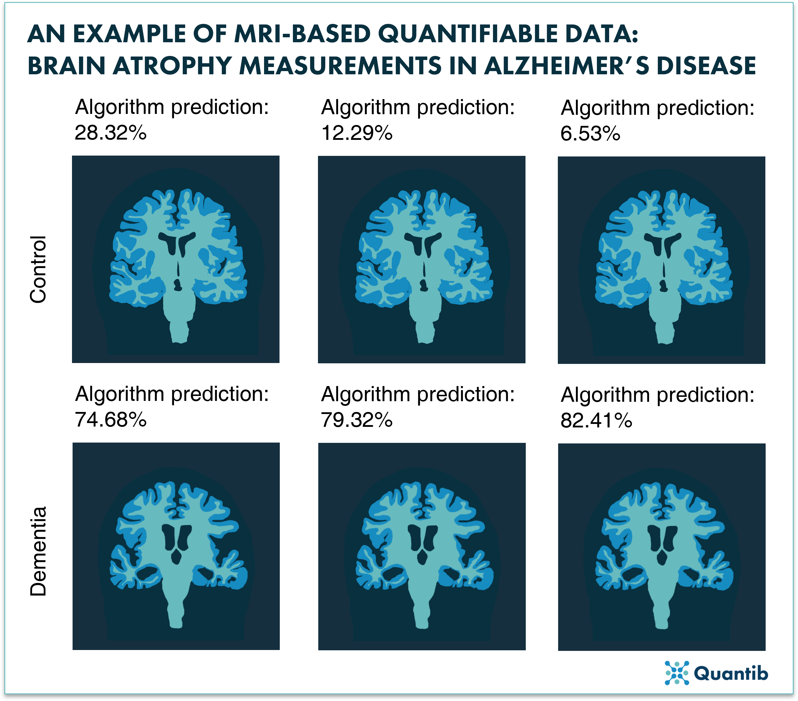 Visualizing Dementia How Developments in CT and MR Imaging help
